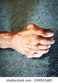 Stiff Big Toe Is A Form Of Degenerative arthritis that Causes Pain And stiffness in The The Joint Where The big Toe joins The Foot. 