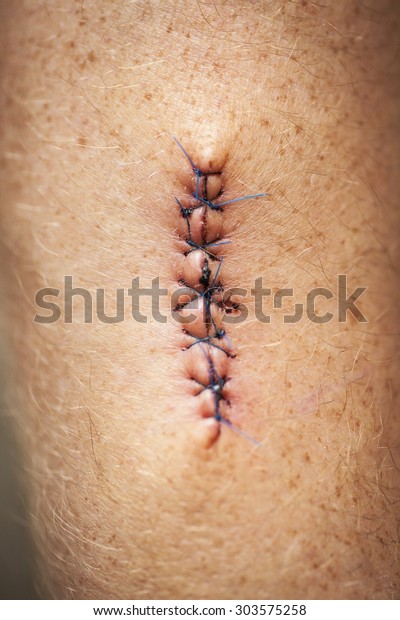 Stitched Skin After Operation Remove Cancerous Stock Photo (Edit Now ...