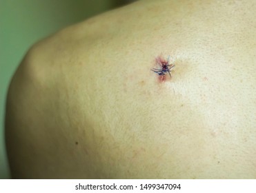 Stitched Up Wound On A Shoulder After A Surgery To Remove An Epidermoid Cyst