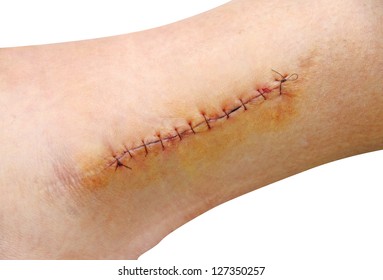 Stitches in the leg (ankle)