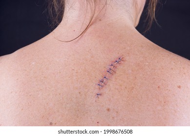 Stitches On The Back Of A Woman After And Operation To Remove A Mole