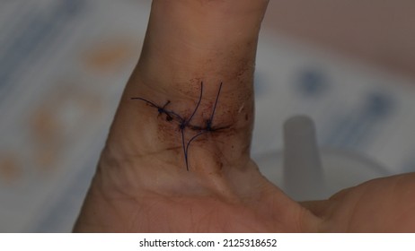 Stitches On A Stab Wound On The Thumb Finger Of A Caucasian Woman's Hand. Very Close View.. Real Photo Taken With Professional Camera Not Processed By Software.