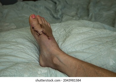 Stitches Removed And Foot Elevated After Bunion Surgery On A Bed.