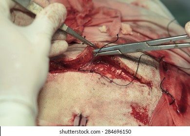 Stitching A Wound After Trepanation (or Craniotomy)