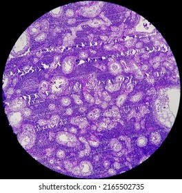 Stomach Cancer: Adenocarcinoma Of Stomach, Antrum Cancer. High Grade Acute Inflammation Near The Tumor Nests. Microscopic View.