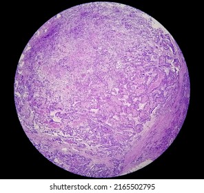 Stomach Cancer: Adenocarcinoma Of Stomach, Antrum Cancer. High Grade Acute Inflammation Near The Tumor Nests. Microscopic View.