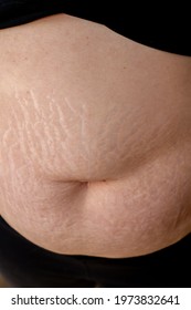 stomach of a fat woman with stretch marks from pregnancy