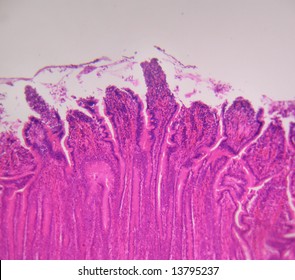 Photo de stock Intestinal Metaplasia Esophagus Aka Barretts Response ...