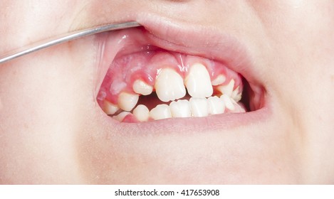 Stomatitis Gingivitis Child Stock Photo (Edit Now) 417653908