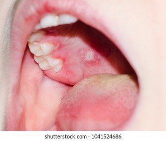 Stomatitis and herpes and fungus in the mouth of a child close-up - Shutterstock ID 1041524686