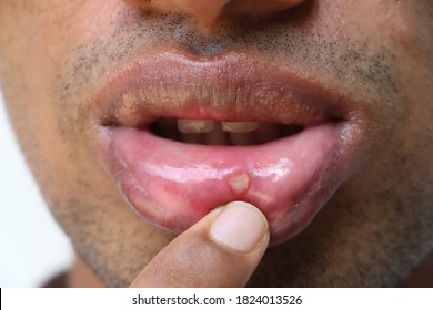 Stomatitis On The Lip Of An Adult. Accidental Injury On The Lip