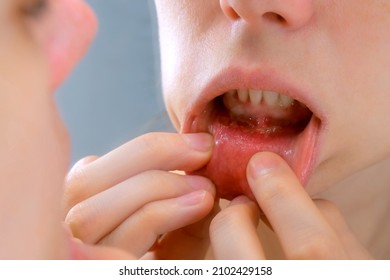 Stomatitis in woman's mouth after dental treatment, disease in the mouth. Stomatitis on the lower lip. Large ulcers in the mouth under the lower teeth. Woman is looking at mirror. - Shutterstock ID 2102429158