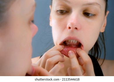 Stomatitis in woman's mouth after dental treatment, disease in the mouth. Stomatitis on the lower lip. Large ulcers in the mouth under the lower teeth. Woman is looking at mirror. - Shutterstock ID 2113544618