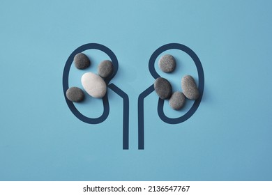 Stones on the silhouette of the kidneys. A symbol of kidney disease. Kidney stones