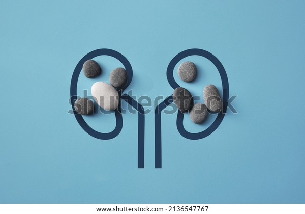 Stones on the silhouette of the kidneys. A\
symbol of kidney disease. Kidney\
stones