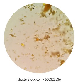 Stool examination test for parasites or eggs in a stool sample with iodine stained under microscope present Entamoeba coli . The parasites are associated with intestinal infections.
 Stock Photo