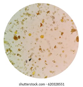Stool examination test for parasites or eggs in a stool sample with iodine stained under microscope present Entamoeba coli . The parasites are associated with intestinal infections.
 Stock Photo
