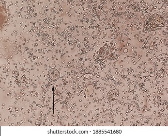 stool smears were taken from a microscope and show the Entamoeba coli cyst stage, and more than four nucleus with arrows are visible. Stock Photo