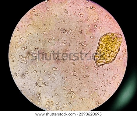 Stool specimen microscopic examination show Cysts of Entamoeba histolytica and Pus cells. Medical and health care concept 