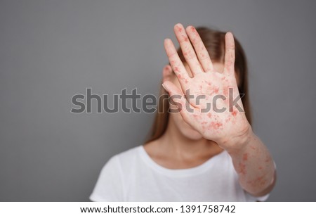Stop Measles. Girl With Virus Closing Face From Camera Over Grey Background