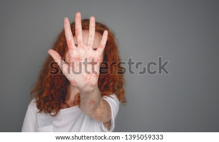 Stop Measles. Woman With Red Spots On Palm Over Grey Background, Copy Space