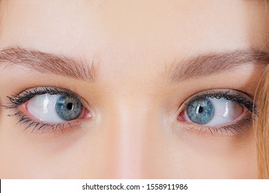 Strabismus Eye Surgery. Close Up Of Crazy Female Eyes With Squint. Eye Muscle Recession. Extraocular Muscle Anatomy