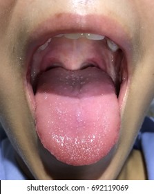 Strawberry Tongue In Case Scarlet Fever.