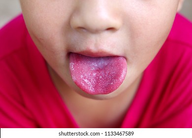 Strawberry Tongue , Scarlet Fever