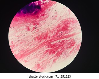 Streptococcus Pneumoniae