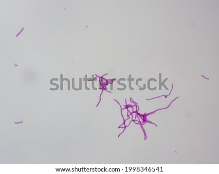 Streptococcus pyogenes gram -positive cocci microscopic 100x image gram stain slide of high vaginal swab (HVS).