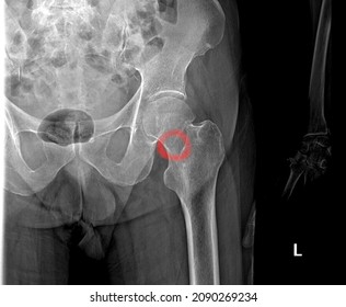 Stress Fracture On The Femoral Neck Showed By Radiograph,xray View.Compression Type Of Stress Fracture. Broken Part Circled With Red. Fracture Is Located On The Medial Part Of Left Femural Neck.