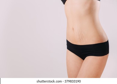 Stretch Marks