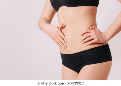 Stretch Marks
