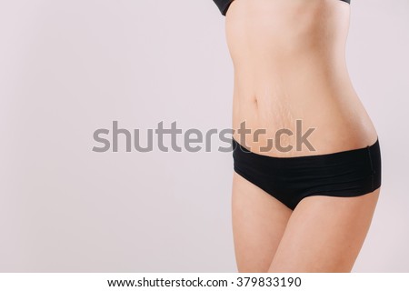 Stretch Marks
