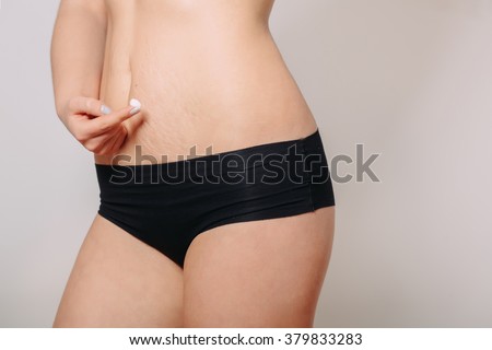 Stretch Marks