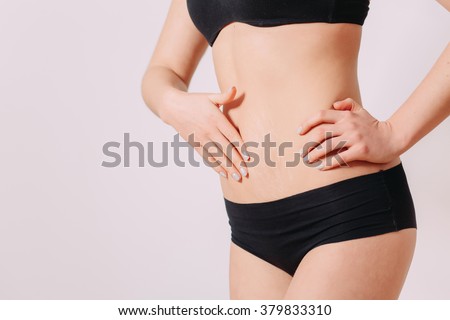Stretch Marks