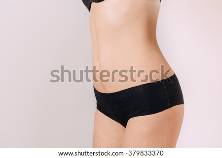 Stretch Marks