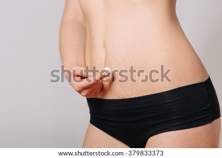 Stretch Marks