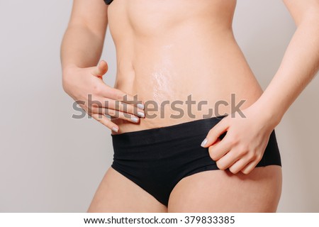 Stretch Marks