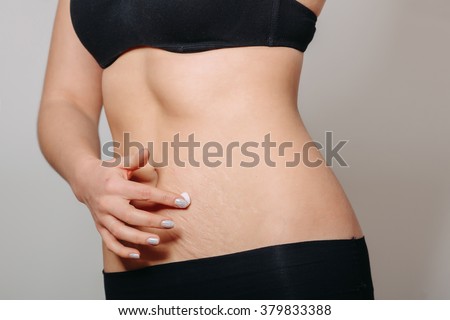 Stretch Marks