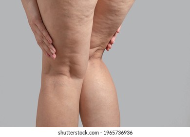 Stretch Marks, Cellulite And Varicose Veins On Female Legs. Copyspace.