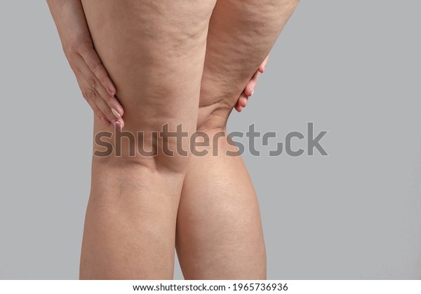 Stretch marks, cellulite and varicose veins on\
female legs. Copyspace.