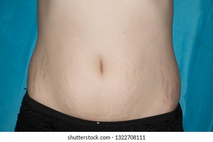 Stretch marks large on the skin of the abdomen of the woman after birth for medicine design
 - Shutterstock ID 1322708111