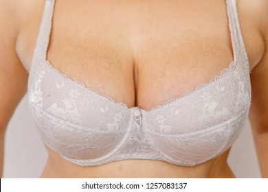 bra marks on chest