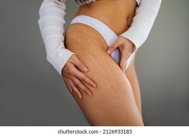 Stretch marks on female legs. A woman's hand holds a fat cellulite and a stretch mark on her leg. Cellulite. - Shutterstock ID 2126933183