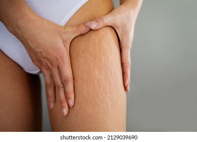 Stretch marks on female legs. A woman's hand holds a fat cellulite and a stretch mark on her leg. Cellulite. - Shutterstock ID 2129039690