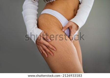 Stretch marks on female legs. A woman's hand holds a fat cellulite and a stretch mark on her leg. Cellulite.
