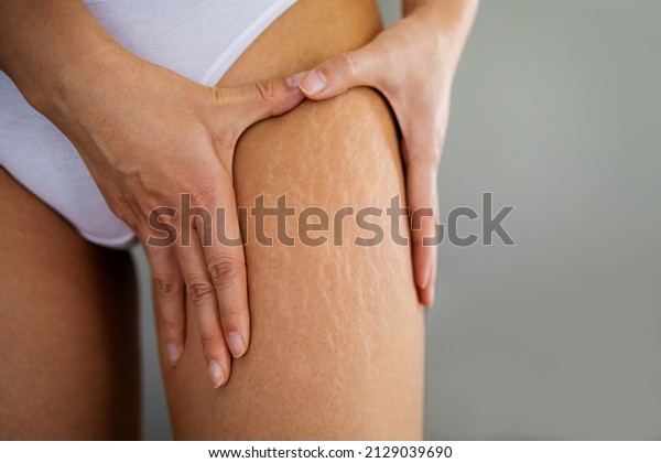 Stretch marks on\
female legs. A woman\'s hand holds a fat cellulite and a stretch\
mark on her leg.\
Cellulite.