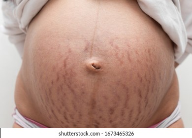 Stretch marks on pregnant woman's bump