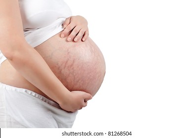 Stretch marks on pregnant woman's bump isolated on white